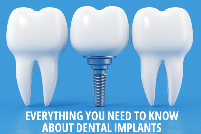 Everything You Need To Know About Dental Implants - Dental Charlotte