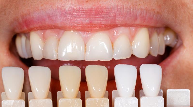 Veneers 